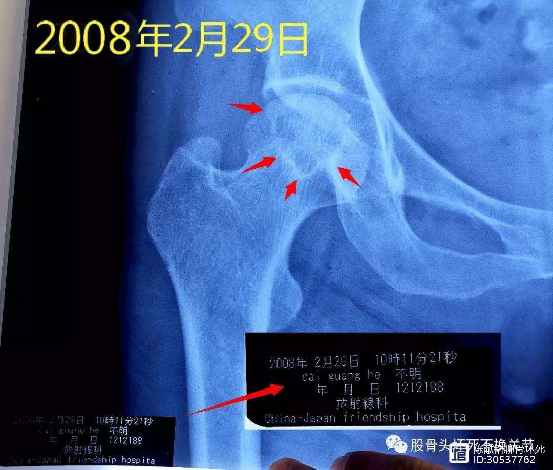 通辽人工骨头医保报销多少(人工骨头医保报销多少比例)